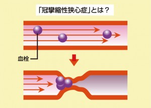 冠攣縮性狭心症