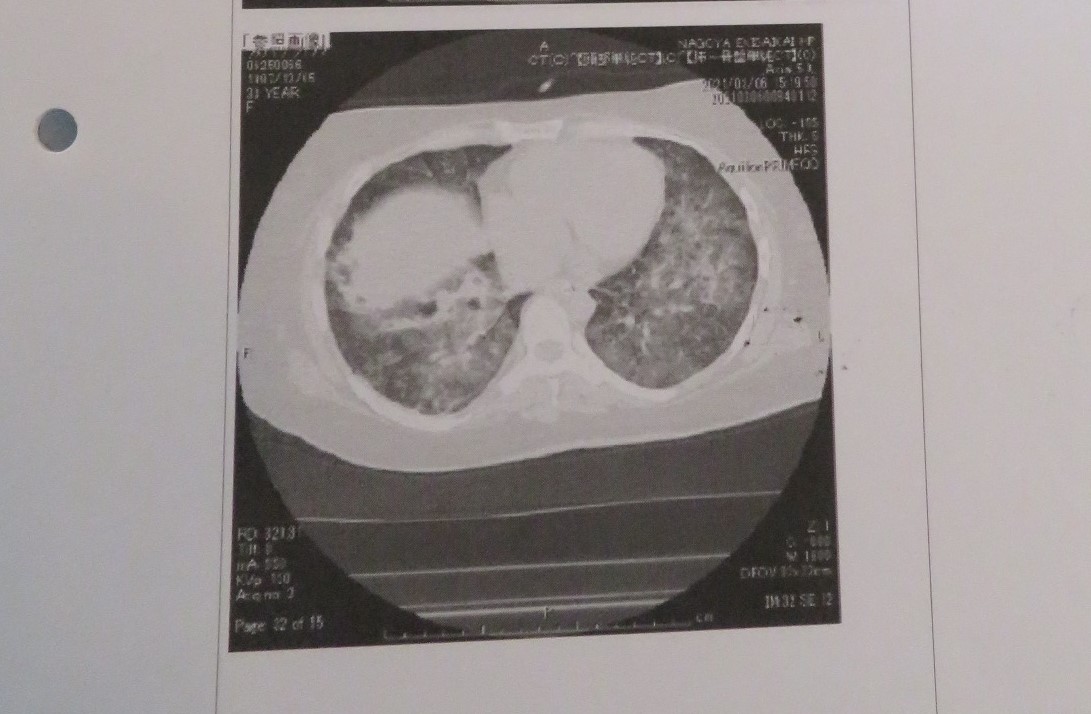 ウィシュマさん死亡時の医師診療録より。肺のCT写真に大きな白い影がある