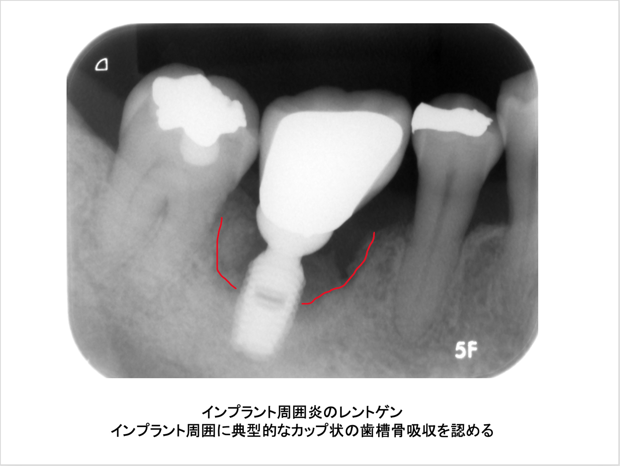 インプラント周囲炎