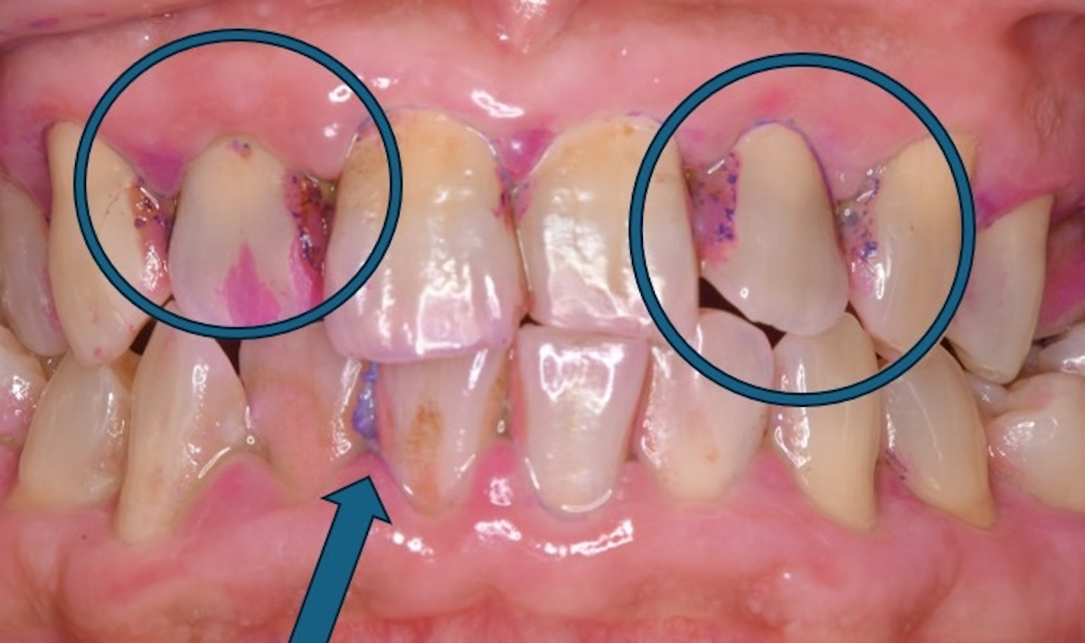 歯間清掃をしていない患者