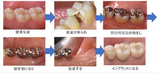 歯が無くなっていく様子