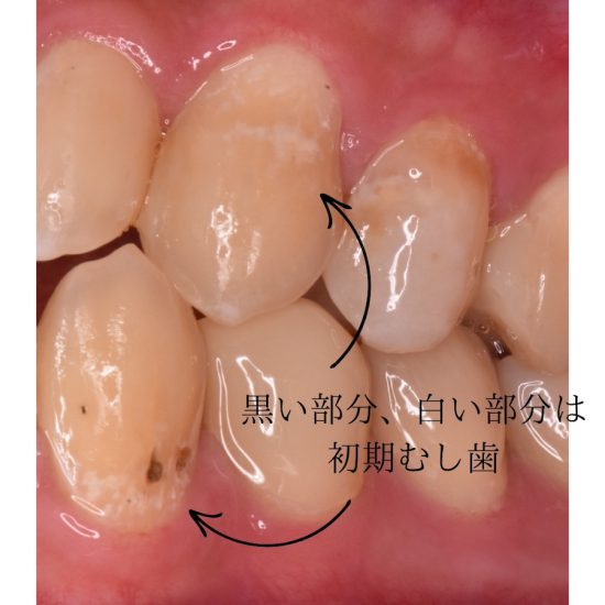 初期むし歯