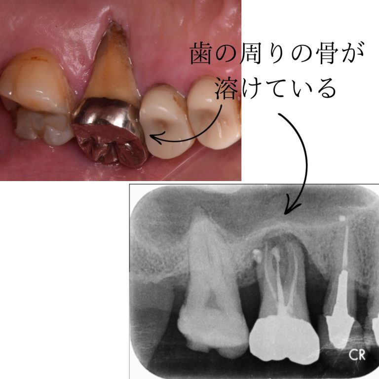 歯周病の影響