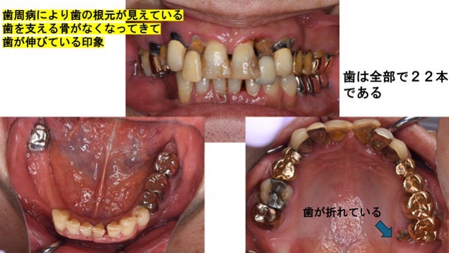 歯周病の進行