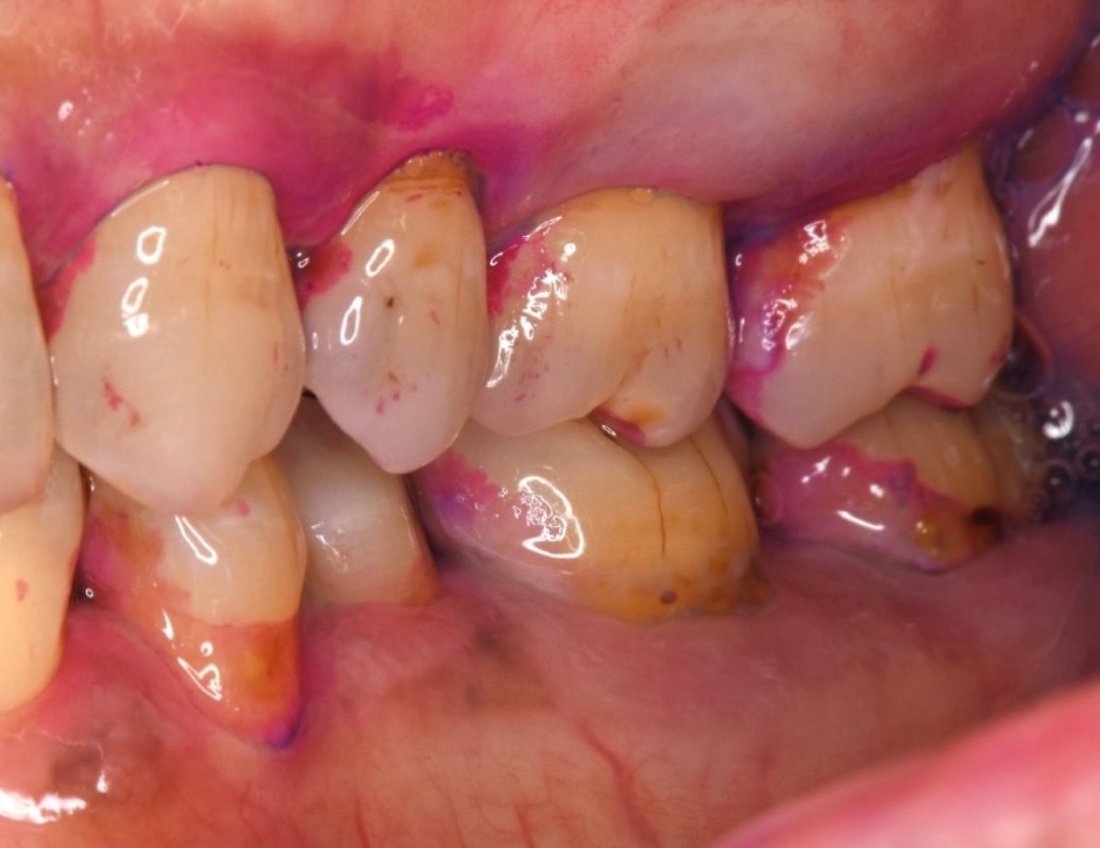 歯と歯の間の歯垢