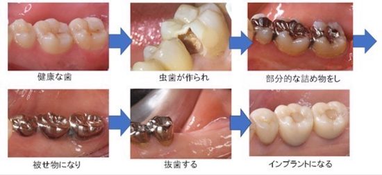 歯の変化